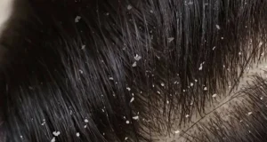 سفیدک های چسبیده به مو چیست؟