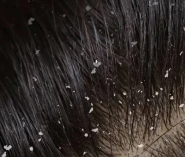 سفیدک های چسبیده به مو چیست؟