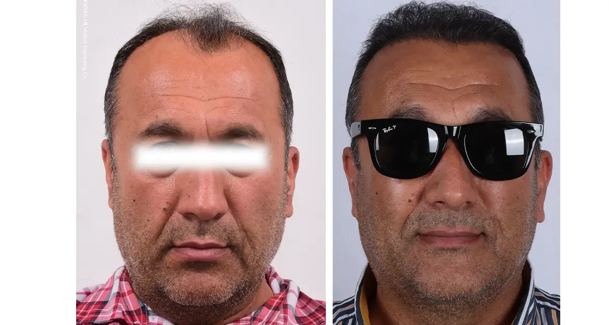 عکس کاشت مو