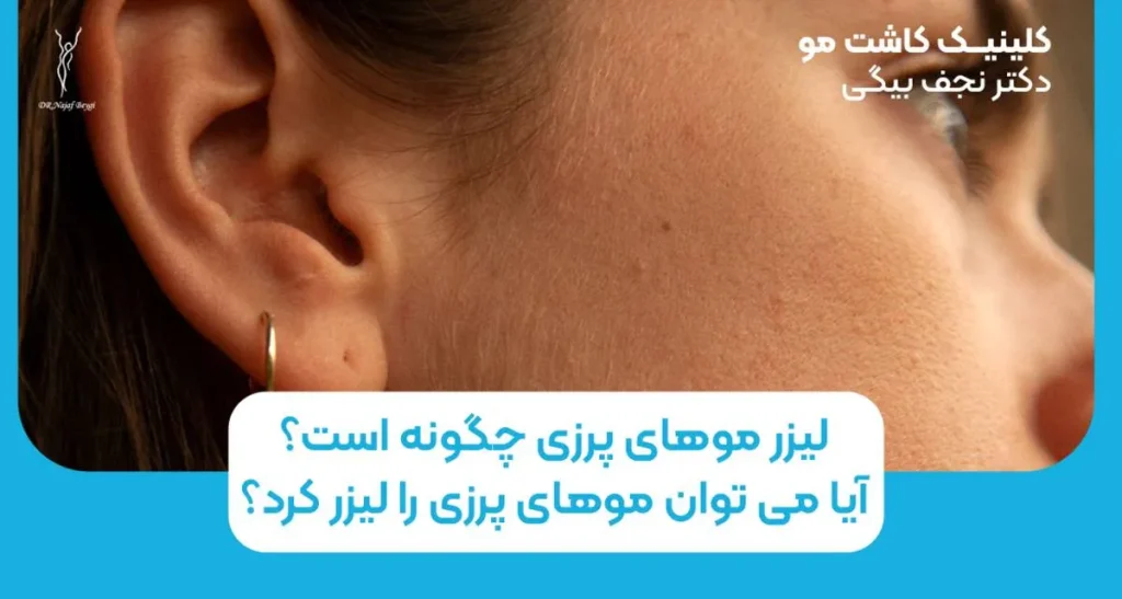 لیزر موهای پرزی چگونه است؟ آیا می توان موهای پرزی را لیزر کرد؟