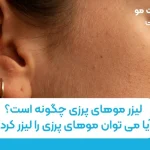 لیزر موهای پرزی چگونه است