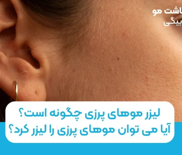 لیزر موهای پرزی چگونه است