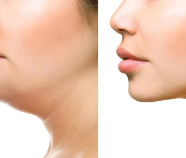 مزوتراپی غبغب چیست و چقدر تاثیر دارد؟