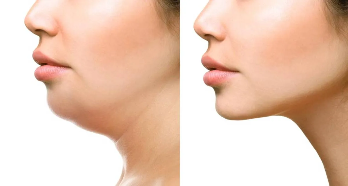 مزوتراپی غبغب چیست و چقدر تاثیر دارد؟ فاصله جلسات چقدر باشد؟