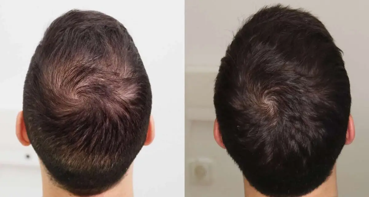 مزوتراپی مو