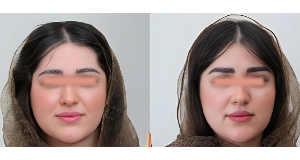 کاشت ابرو به روش BHT
