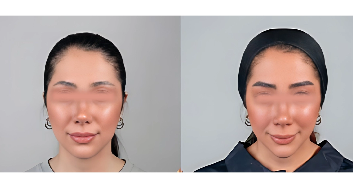 کاشت ابرو به روش FIT