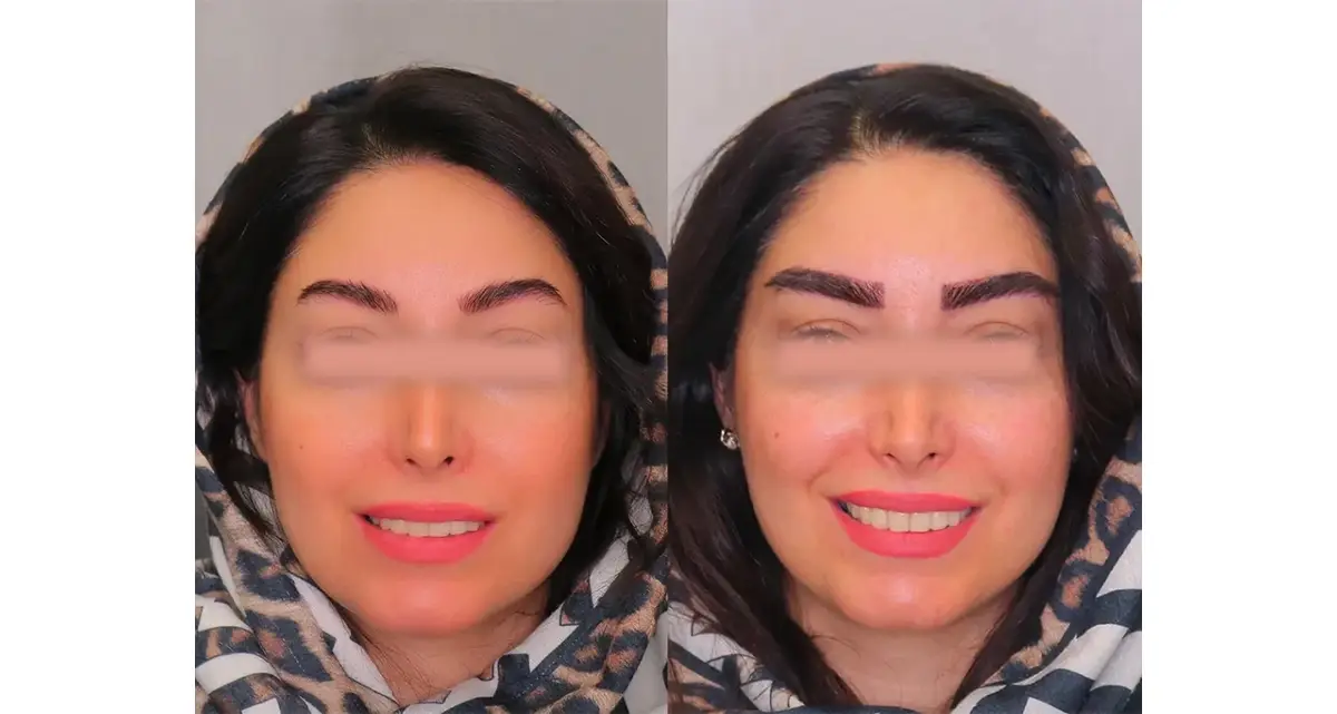 کاشت ابرو به روش SUT