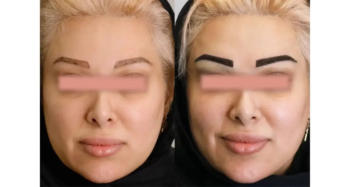 کاشت ابرو به روش بایوفایبر