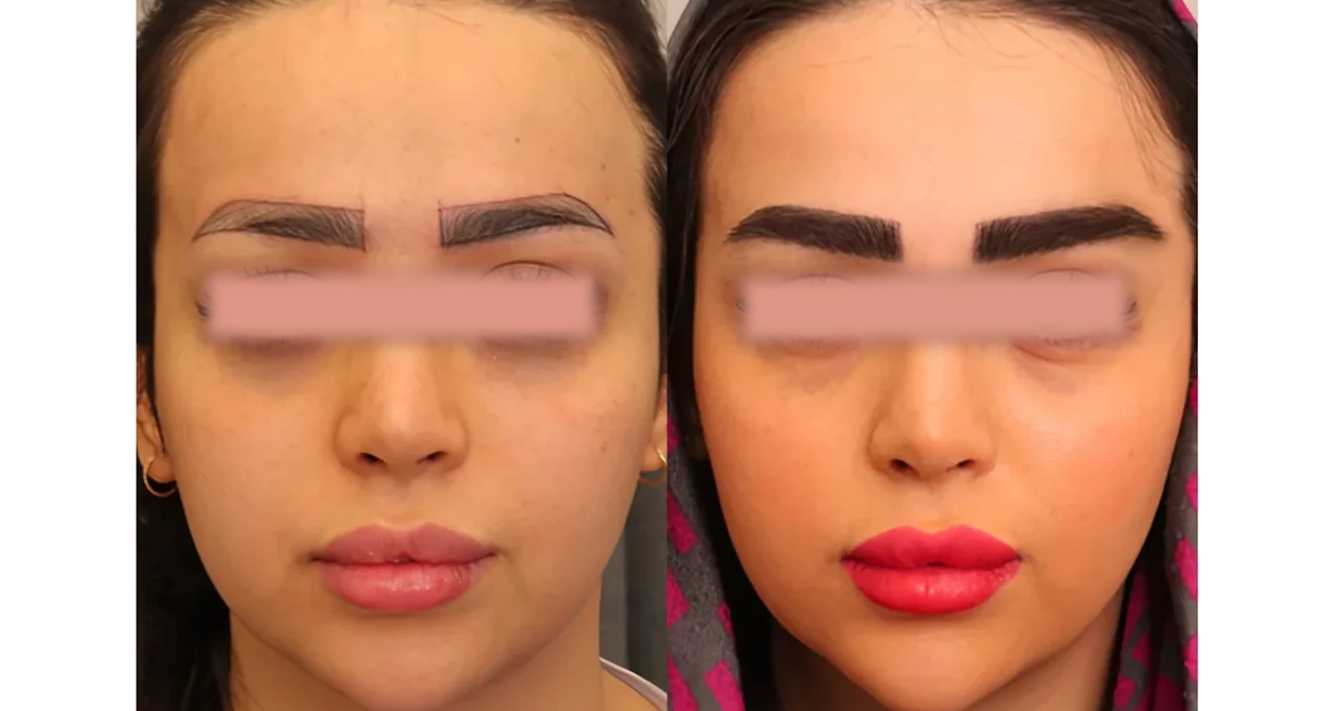 کاشت ابرو به روش میکروگرافت