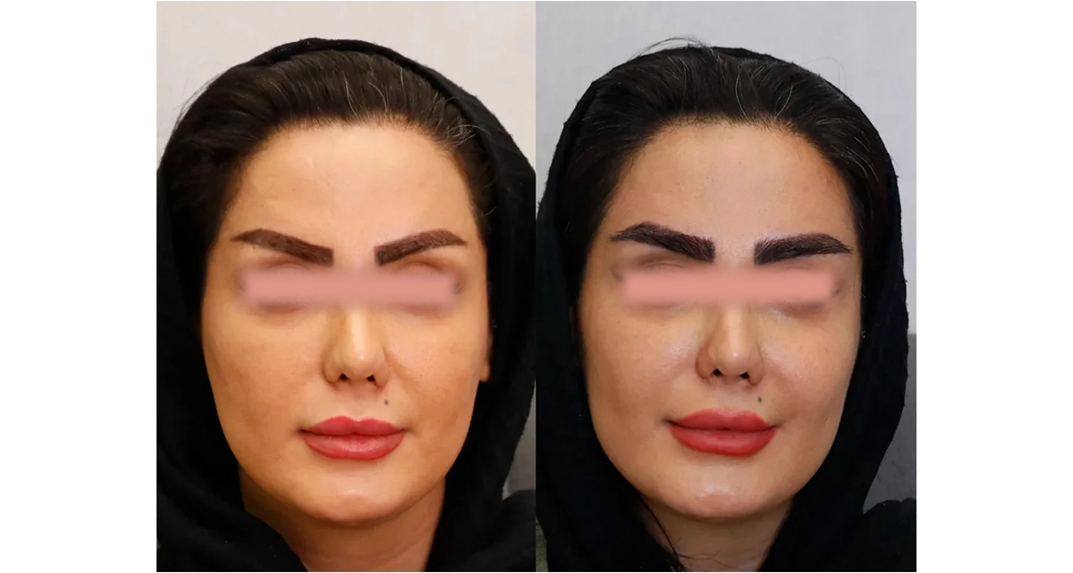 کاشت ابرو به روش نیوگرافت