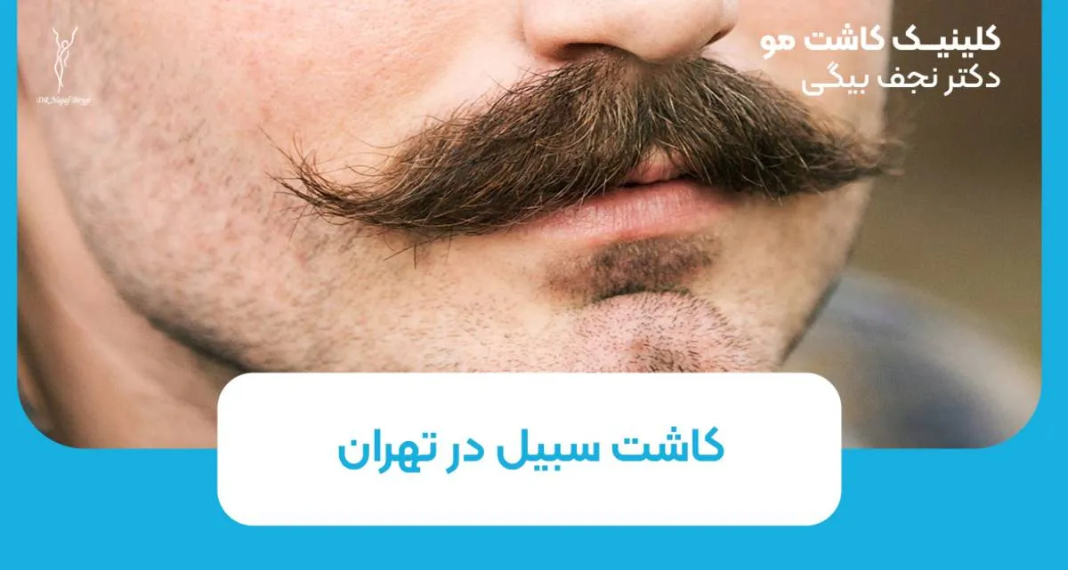 کاشت سبیل در تهران