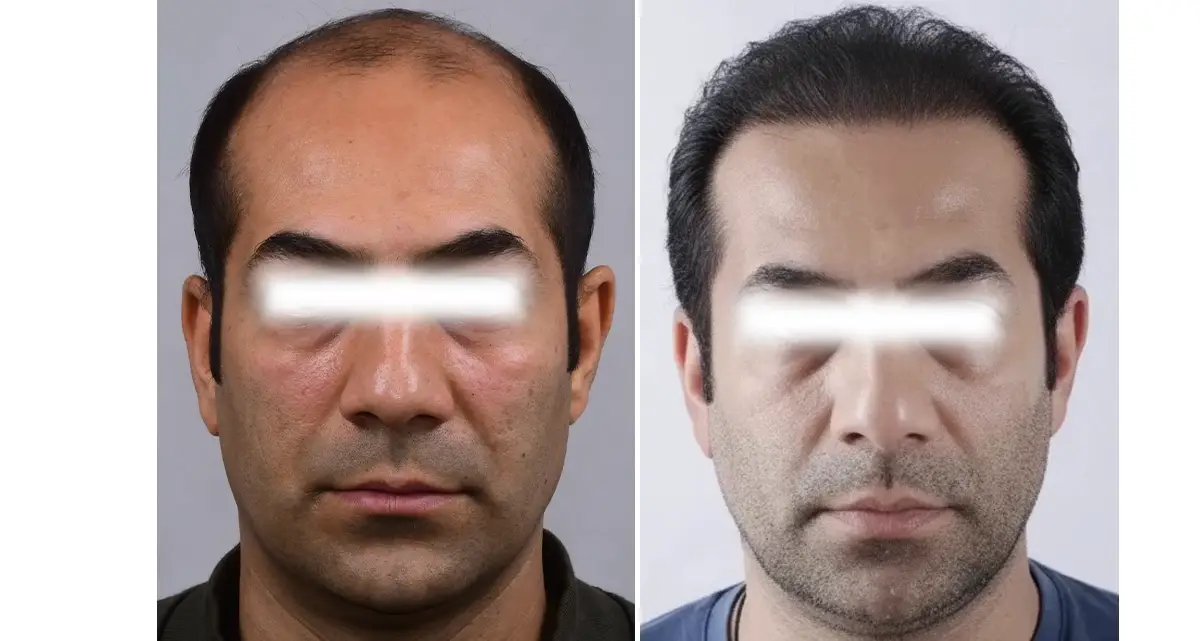 کاشت مو Super FUE