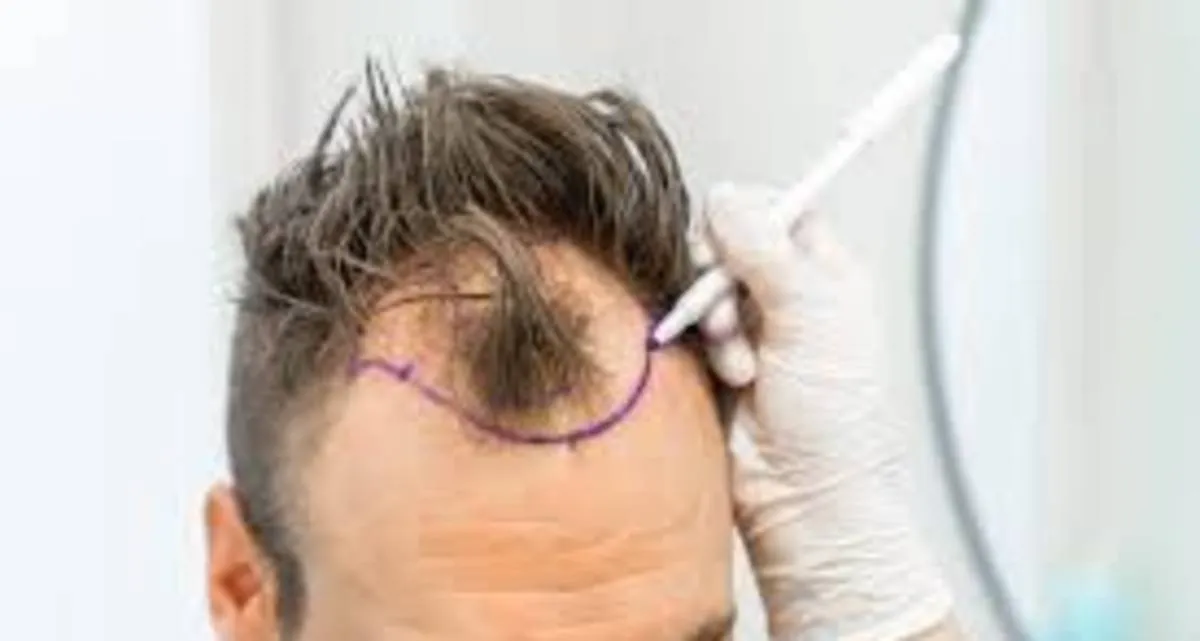 کاشت مو از زیر بغل جواب می دهد؟