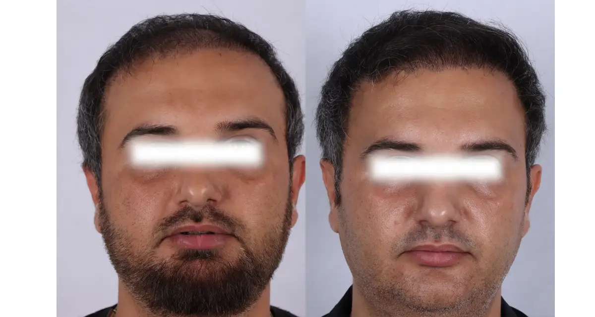 کاشت مو بدون جراحی