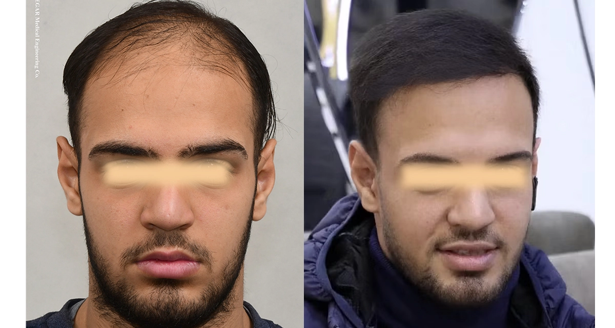 کاشت مو به روش BHT