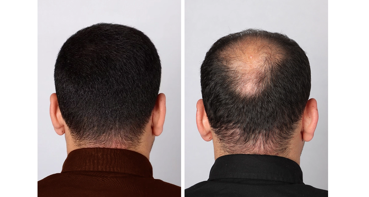 کاشت مو به روش DHI