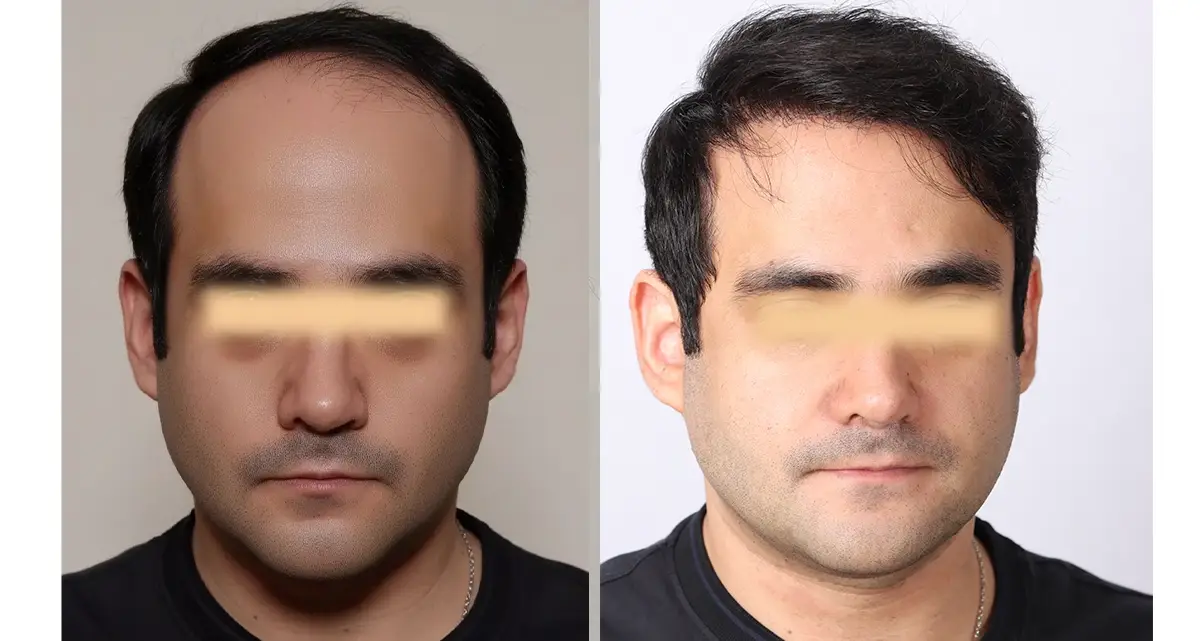 کاشت مو به روش artas