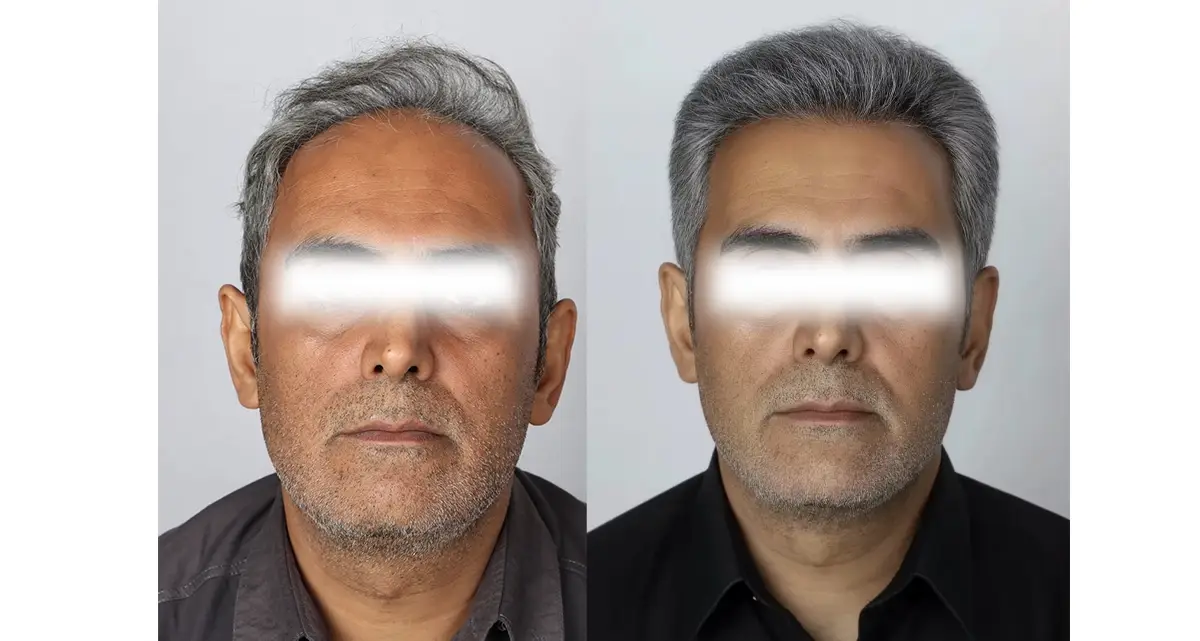 کاشت مو به روش fit