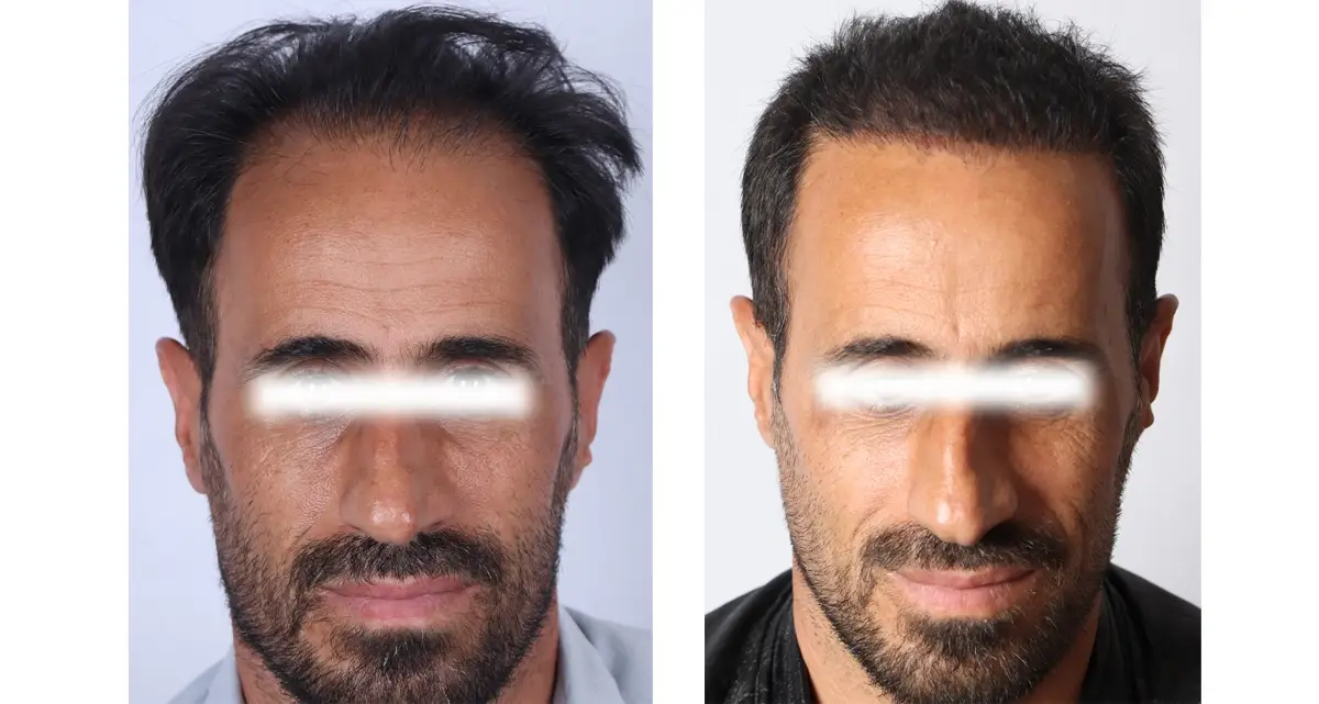 کاشت مو به روش سیفر