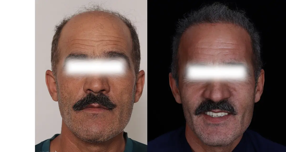 کاشت مو به روش میکروفیت