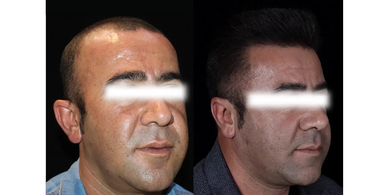 کاشت مو به روش میکروگرافت