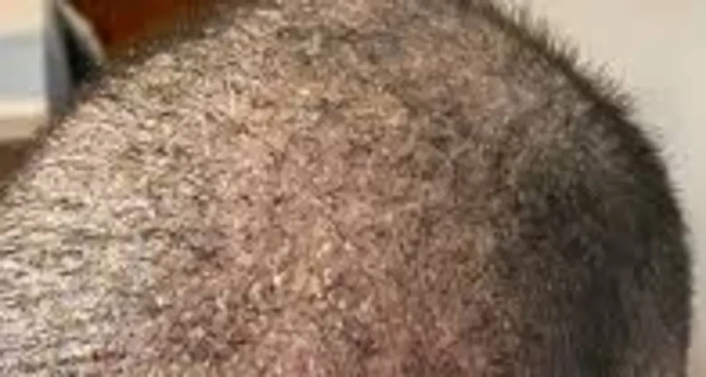 آیا شوره سر بعد از کاشت مو طبیعی است؟