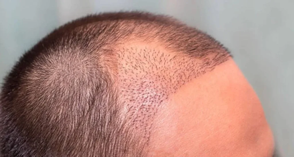 آیا کاشت موی دوم امکان‌پذیر است