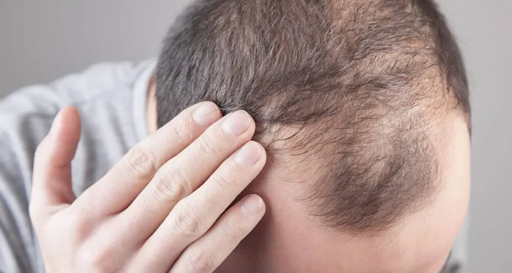 آیا کاشت مو برای بار دوم ممکن است؟