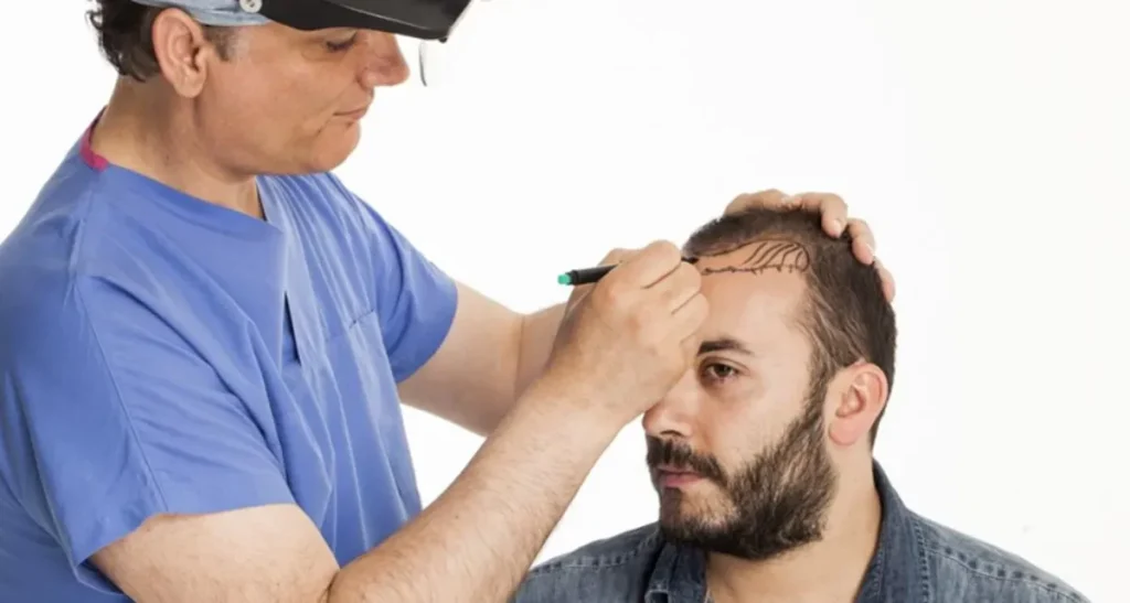 بهترین دکتر کاشت مو در تهران