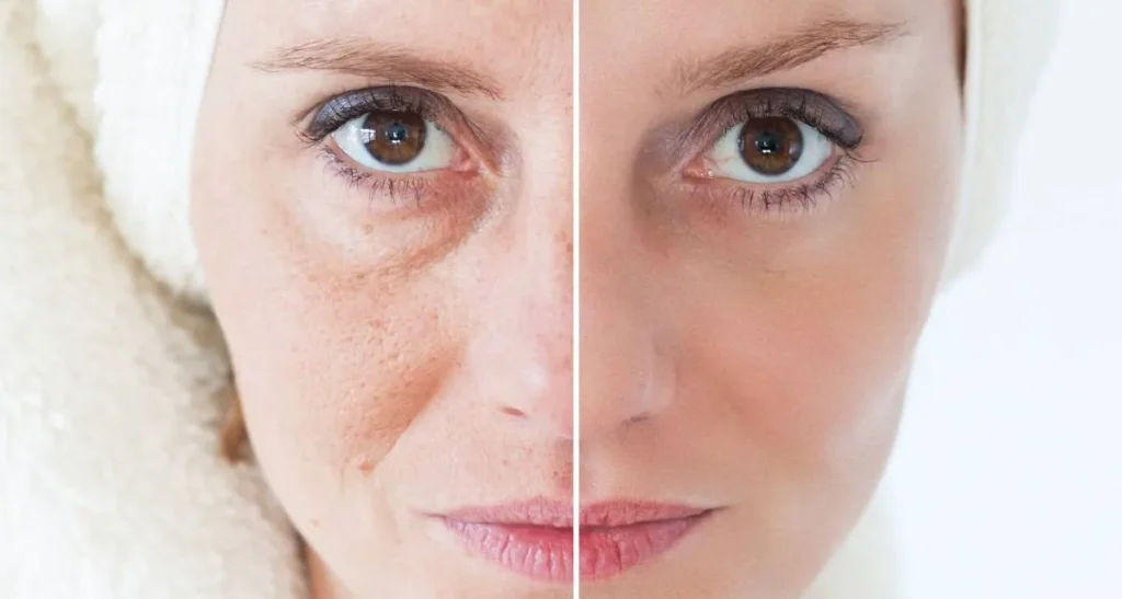 بهترین روشهای جوانسازی پوست