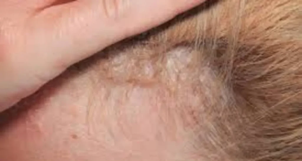 تاثیر قارچ و شوره سر بر کاشت مو