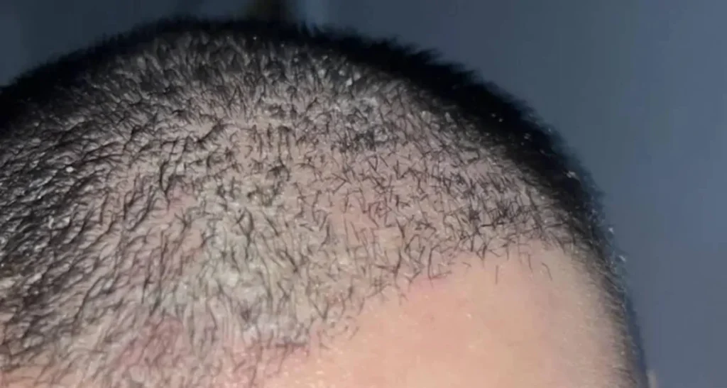 خشکی پوست سر بعد از کاشت مو