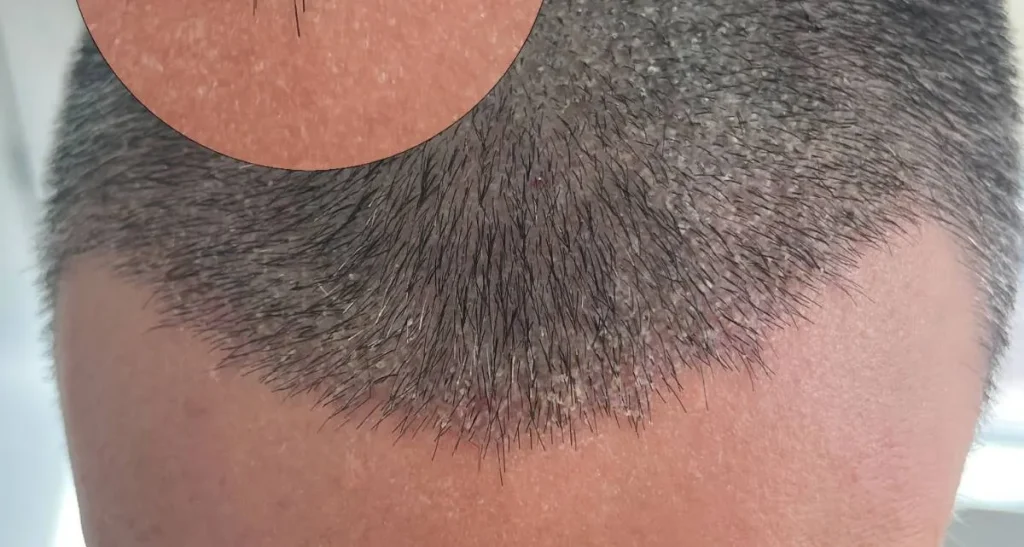 علت و نحوه درمان شوره سر بعد از کاشت مو