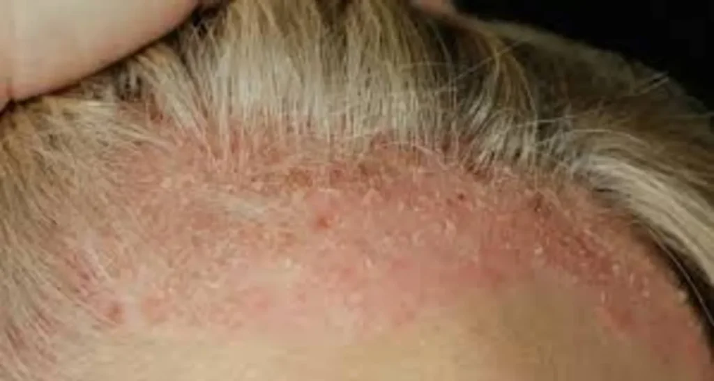 علت پوسته شدن سر بعد از کاشت مو