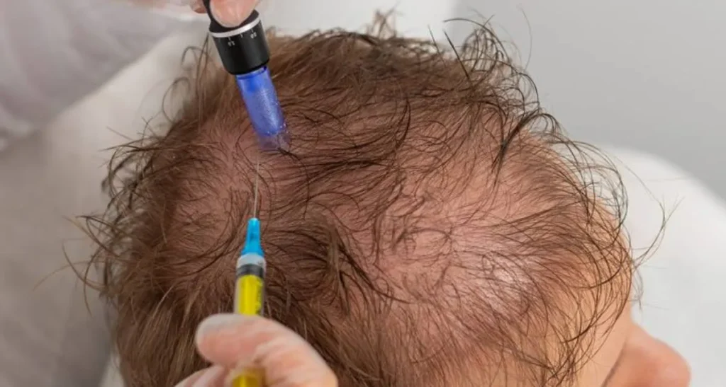 عوارض مزونیدلینگ مو