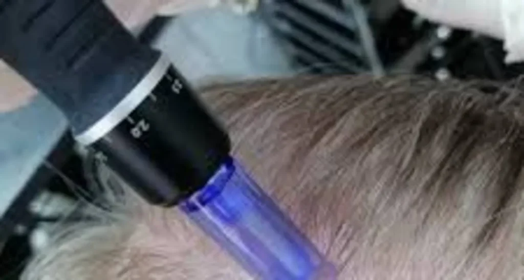 مزونیدلینگ مو چیست؟