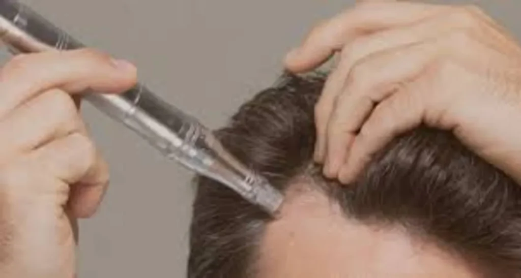 مزونیدلینگ مو چیست و چه تاثیری در درمان ریزش مو دارد