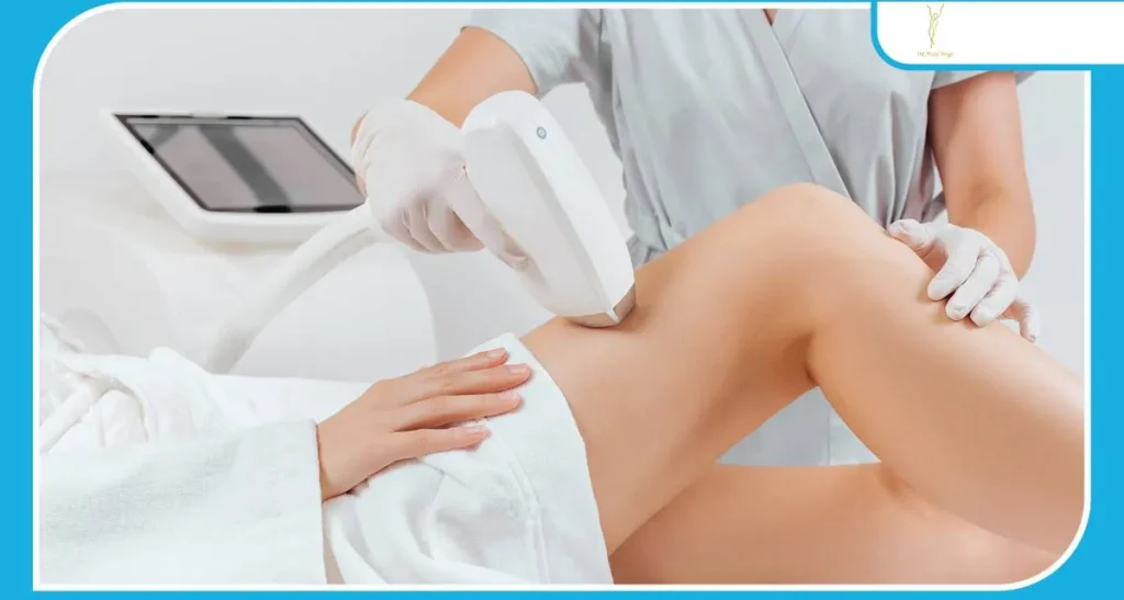 تنبلی تخمدان و لیزر موهای زائد