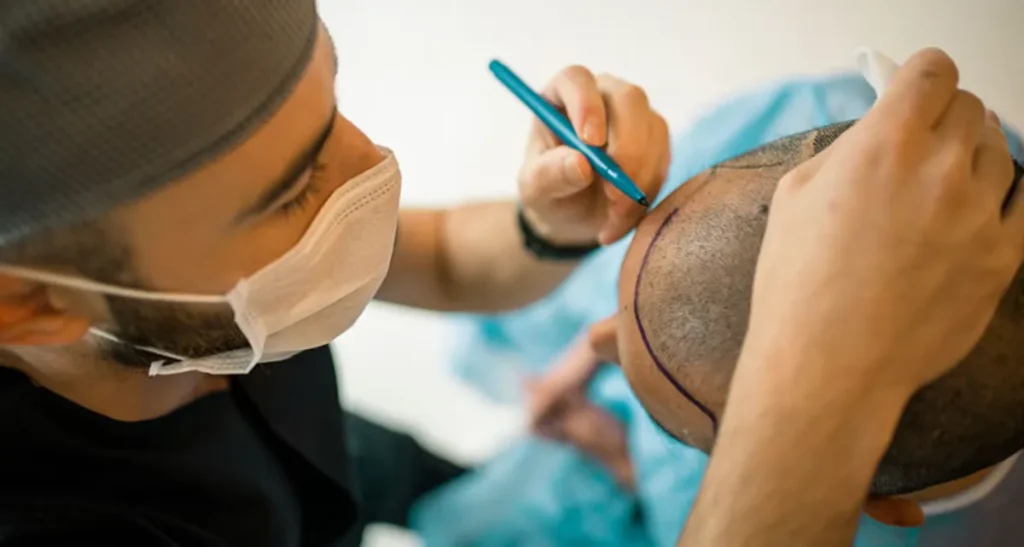 نکات انتخاب بهترین دکتر کاشت مو در تهران