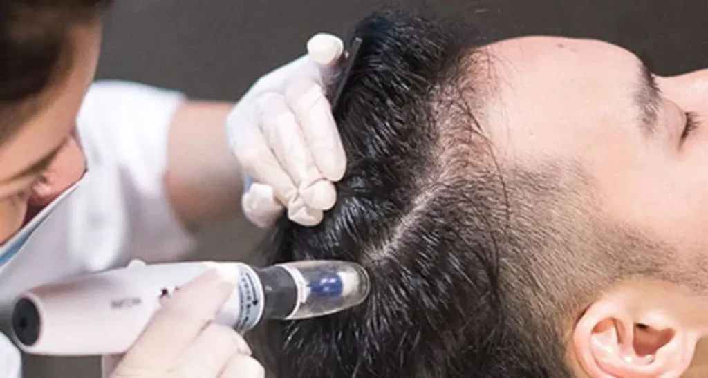 هزینه مزونیدلینگ مو