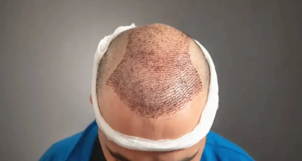 کاشت مجدد مو