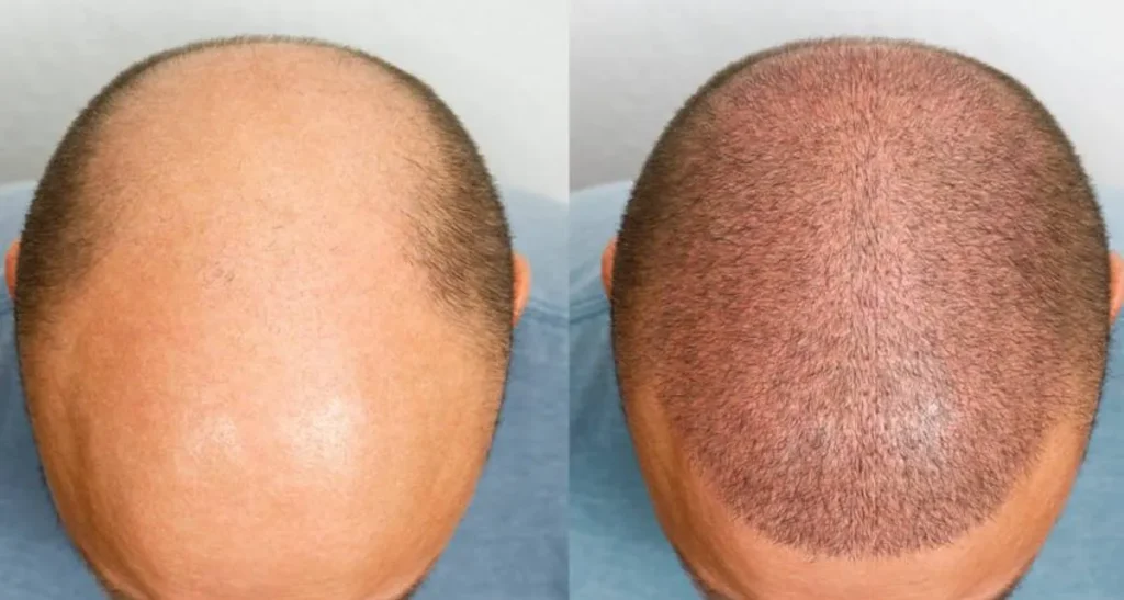 کاشت مو برای بار دوم