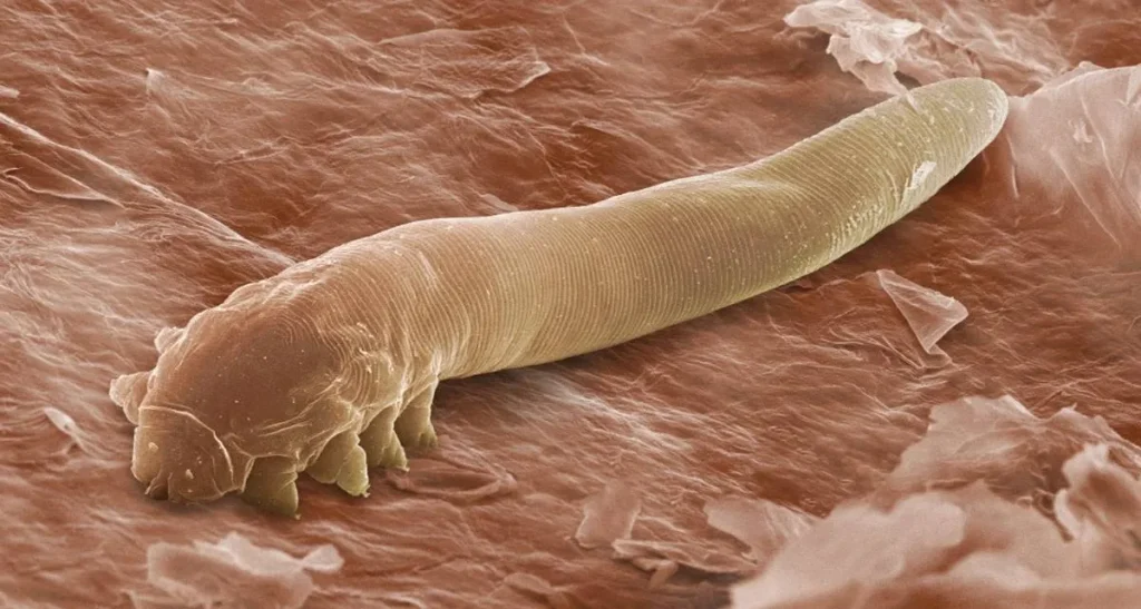 انگل دمودکس و راه های درمان آن