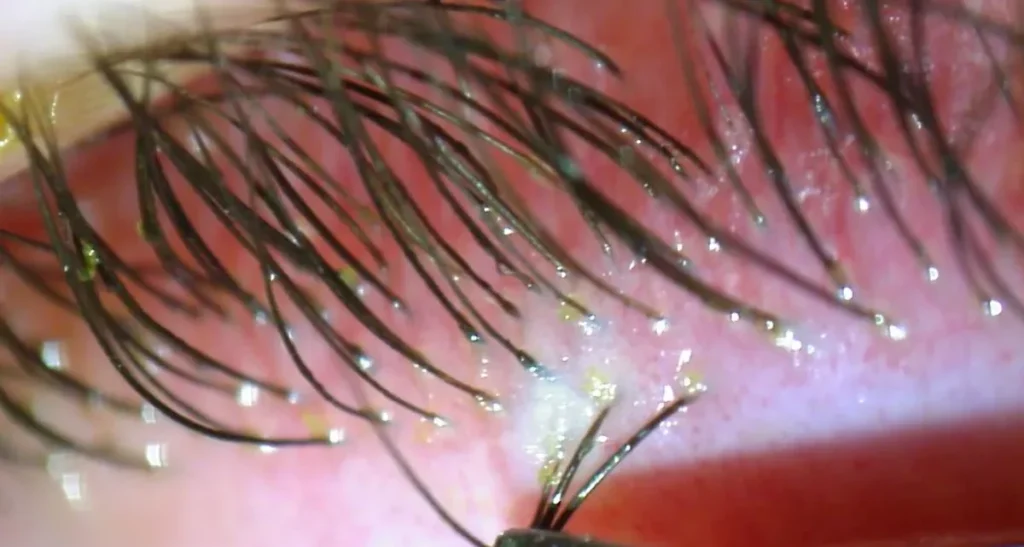 انگل دمودکس چیست