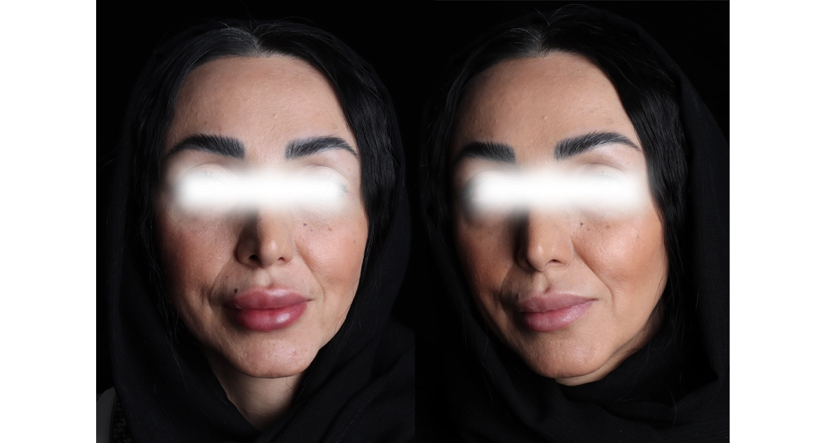 تزریق آنزیم صورت