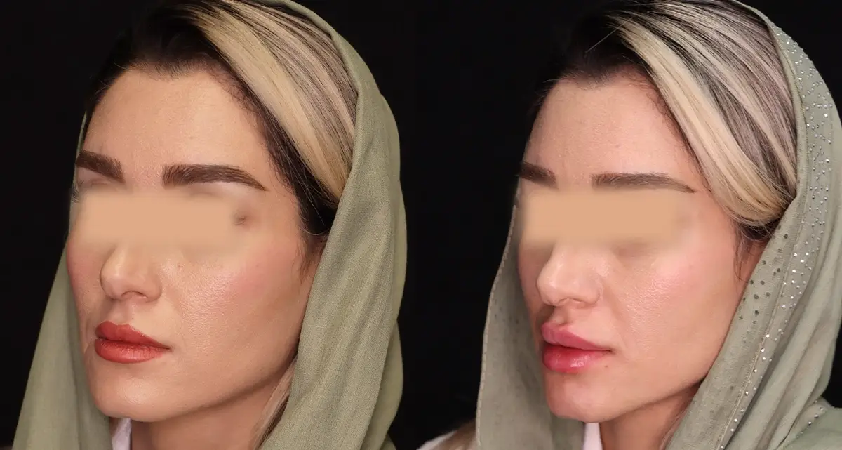 تزریق فیلر به صورت