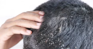 علت شوره سر بعد از کاشت مو+ راه درمان و پیشگیری