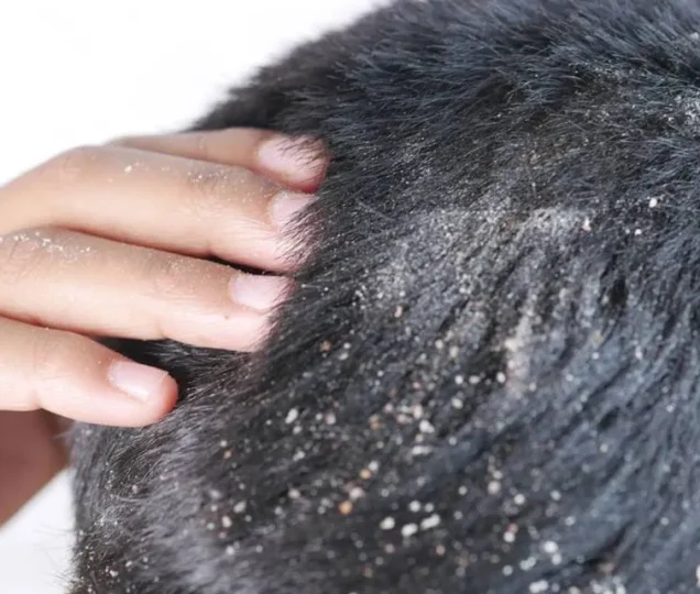 علت شوره سر بعد از کاشت مو+ راه درمان و پیشگیری