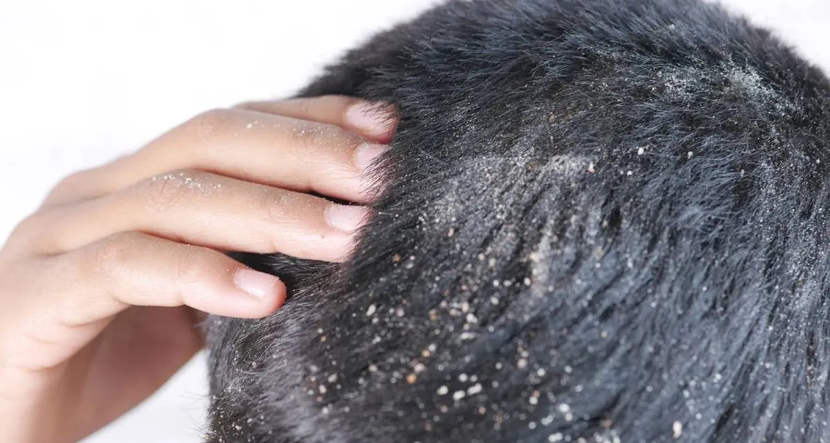 علت شوره سر بعد از کاشت مو+ راه درمان و پیشگیری